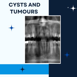 cysts and tumores