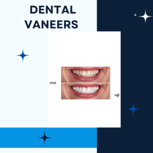 dental veneers treatment