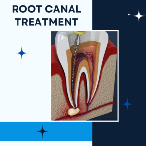Root canal traetment