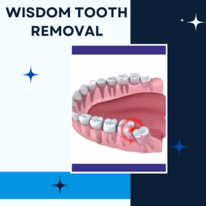 wisdom tooth removal