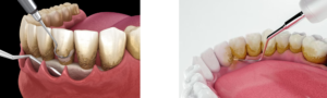 gum surgeries