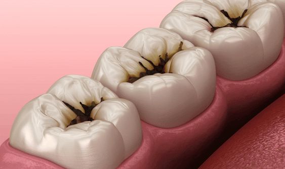 ROOT CANAL TREATMENT