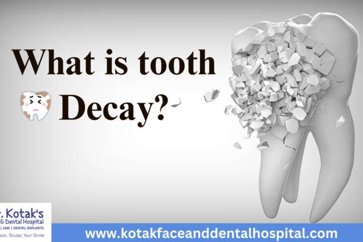 Illustration of a tooth with cavities showing the stages of tooth decay, explained by Dr. Kotak's Face and Dental Hospital.