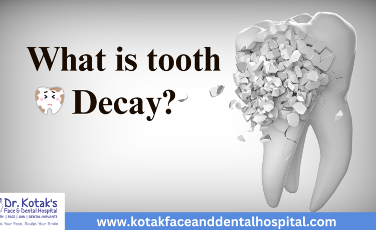 Illustration of a tooth with cavities showing the stages of tooth decay, explained by Dr. Kotak's Face and Dental Hospital.
